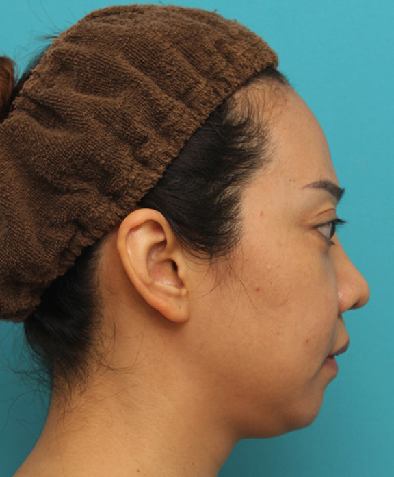 症例写真,ウルセラシステムで顔と顎下のたるみを引き締めた30代後半女性の症例写真,Before,ba_ulthera019_b02.jpg