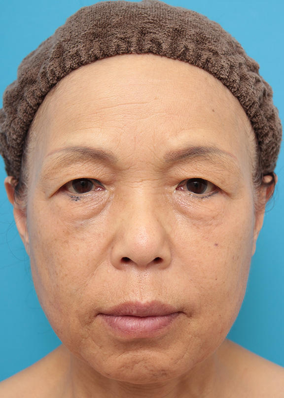 注射式シワ取り 長期持続型ヒアルロン酸注入,目の下、法令線、口周りシワにヒアルロン酸を6本注射した60代女性の症例写真,After,ba_hyaluronic031_a01.jpg