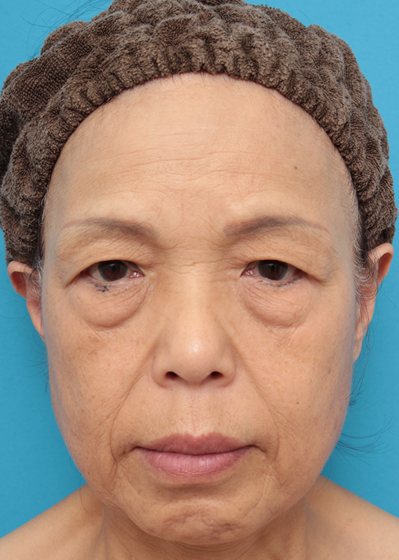 症例写真,目の下、法令線、口周りシワにヒアルロン酸を6本注射した60代女性の症例写真,Before,ba_hyaluronic031_b01.jpg