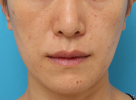 症例写真,ボツリヌストキシン注射で下がっている口角を上げた40代後半女性の症例写真,After（1ヶ月後）,ba_lipsup_botox006_b01.jpg