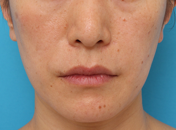 症例写真,ボツリヌストキシン注射で下がっている口角を上げた40代後半女性の症例写真,Before,ba_lipsup_botox006_b01.jpg