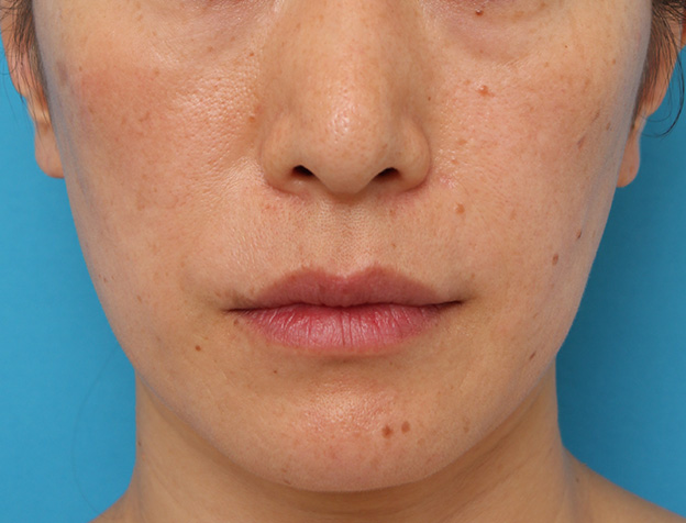 症例写真,ボツリヌストキシン注射で下がっている口角を上げた40代後半女性の症例写真,注射直後,mainpic_lipsup_botox006b.jpg