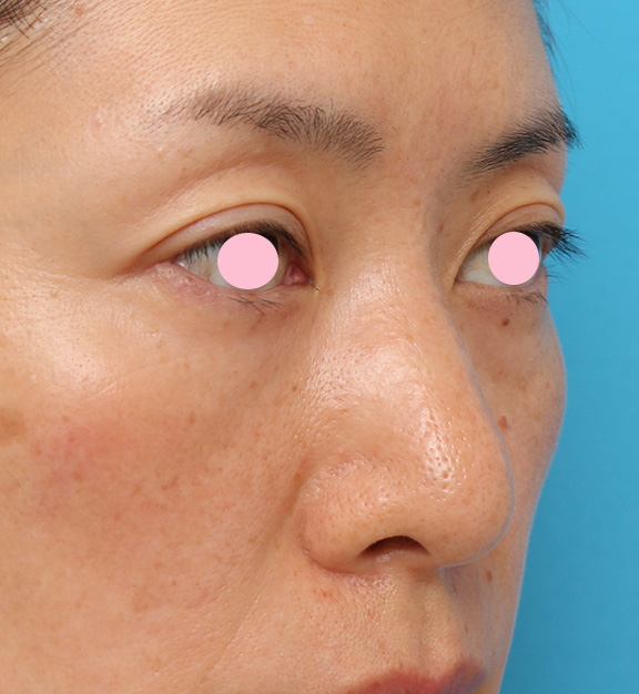 症例写真,骨切り幅寄せ手術で鼻の横幅を小さくした40代女性の症例写真,Before,ba_honekiri009_b02.jpg