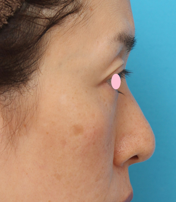 症例写真,骨切り幅寄せ手術で鼻の横幅を小さくした40代女性の症例写真,Before,ba_honekiri009_b03.jpg