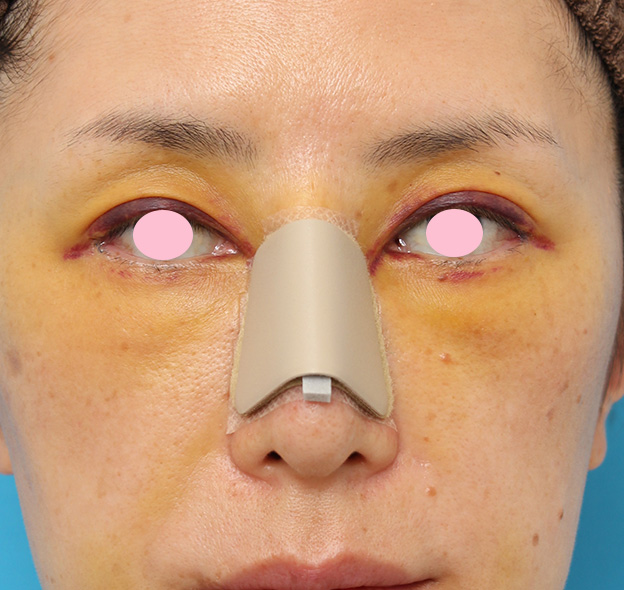 症例写真,骨切り幅寄せ手術で鼻の横幅を小さくした40代女性の症例写真,4日後,mainpic_honekiri009c.jpg