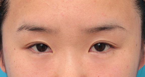 その人の目に一番合ったラインで二重まぶた全切開法をした症例写真,After（7ヶ月後）,ba_sekkai053_a01.jpg