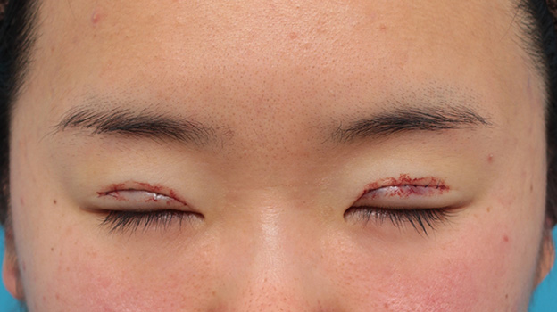 症例写真,その人の目に一番合ったラインで二重まぶた全切開法をした症例写真,手術直後,目を閉じた状態,mainpic_sekkai053c.jpg