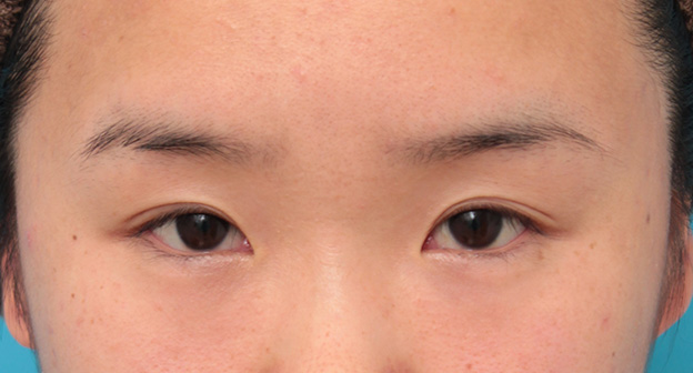 症例写真,その人の目に一番合ったラインで二重まぶた全切開法をした症例写真,7ヶ月後,目を開けた状態,mainpic_sekkai053j.jpg