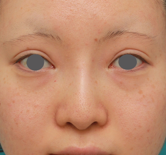 症例写真,鼻のヒアルロン酸を溶解し、シリコンプロテーゼ+鼻先耳介軟骨移植をした症例写真,After（6ヶ月後）,ba_ryubi1046_b01.jpg