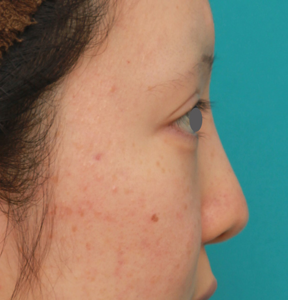 症例写真,鼻のヒアルロン酸を溶解し、シリコンプロテーゼ+鼻先耳介軟骨移植をした症例写真,After（6ヶ月後）,ba_ryubi1046_b03.jpg