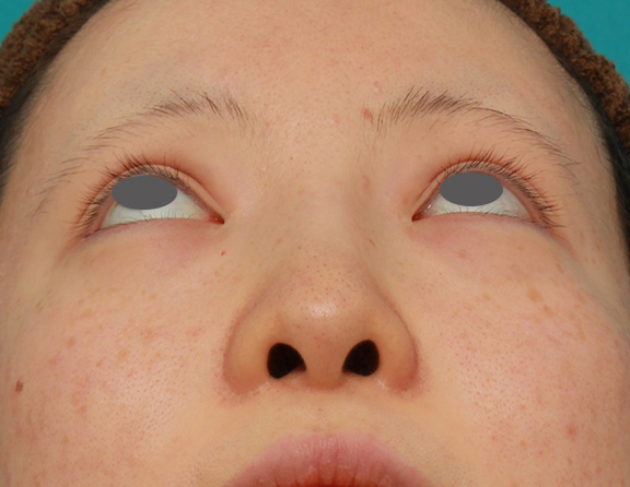 症例写真,鼻のヒアルロン酸を溶解し、シリコンプロテーゼ+鼻先耳介軟骨移植をした症例写真,After（6ヶ月後）,ba_ryubi1046_b04.jpg