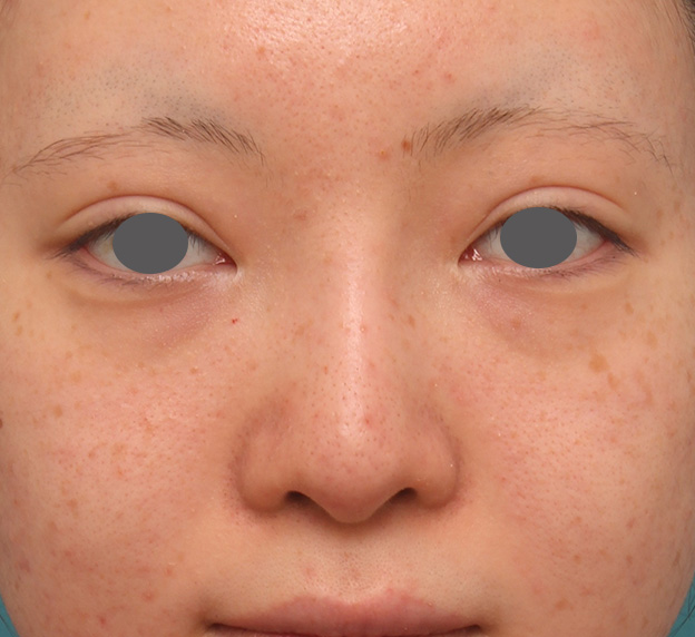 症例写真,鼻のヒアルロン酸を溶解し、シリコンプロテーゼ+鼻先耳介軟骨移植をした症例写真,3週間後,mainpic_ryubi1046d.jpg