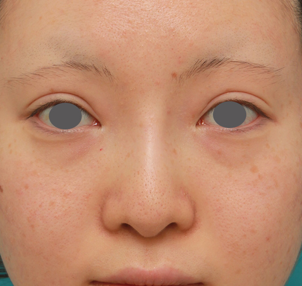 症例写真,鼻のヒアルロン酸を溶解し、シリコンプロテーゼ+鼻先耳介軟骨移植をした症例写真,6ヶ月後,mainpic_ryubi1046e.jpg