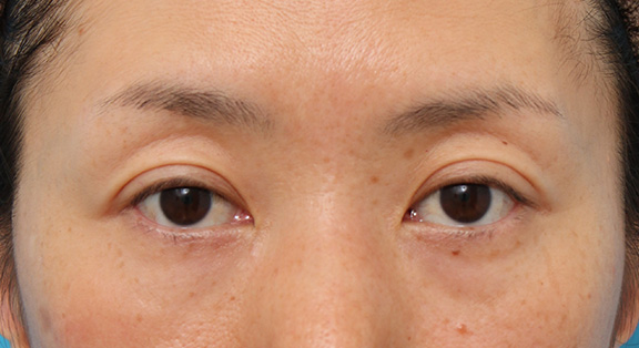 症例写真,目尻切開で目を外側に広げた40代後半の女性の症例写真,Before,ba_mejiri016_b01.jpg