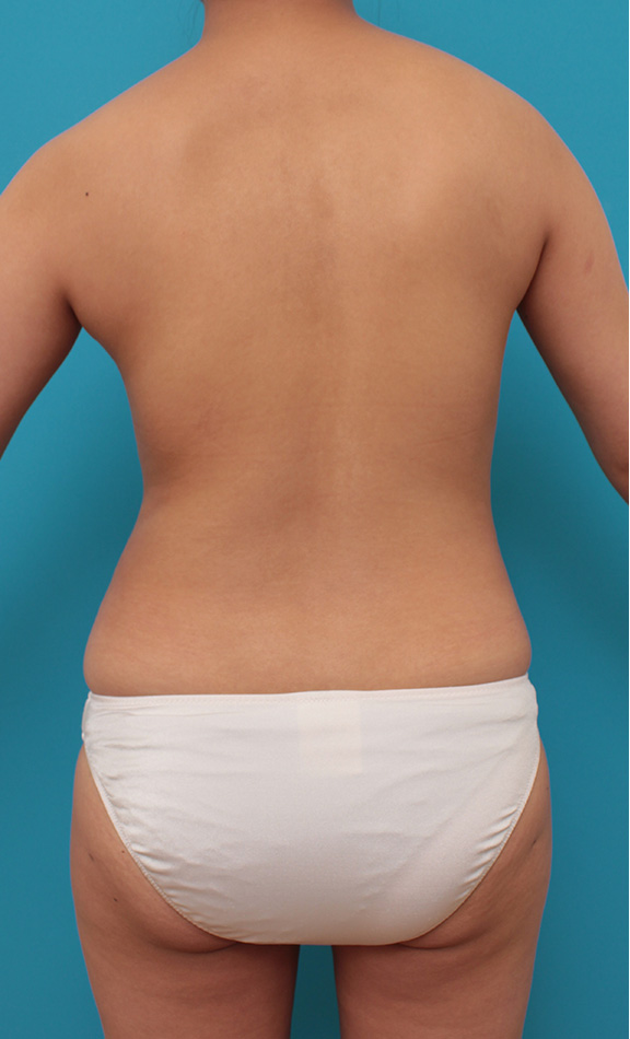 症例写真,ピュアコンデンス脂肪注入豊胸の症例 お腹周りの脂肪吸引とバスト脂肪注入の20代女性,Before,ba_shibokyuin031_b04.jpg
