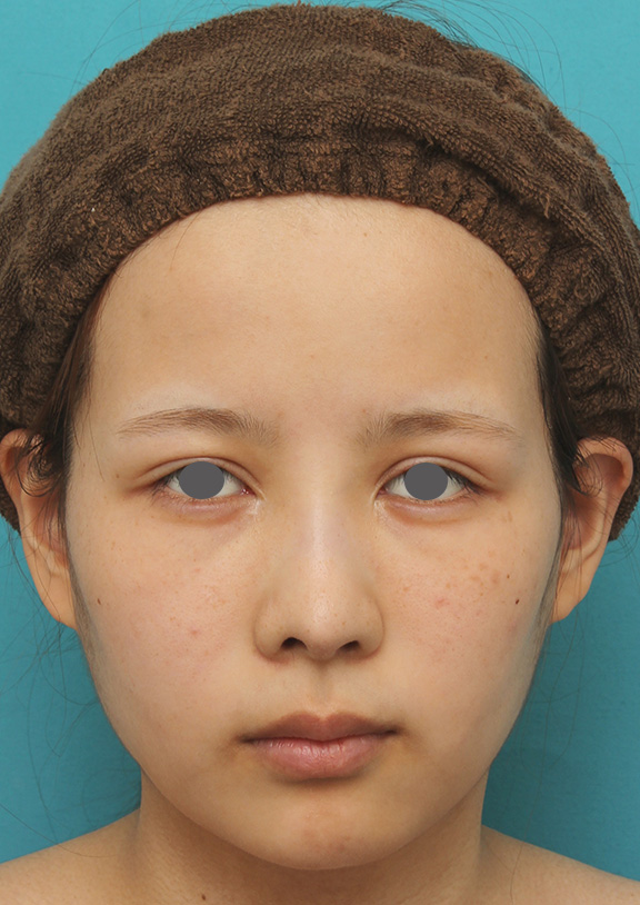 顎にシリコンプロテーゼを入れ、Eラインを整えた20代女性の症例写真,After（6ヶ月後）,ba_ago014_a01.jpg