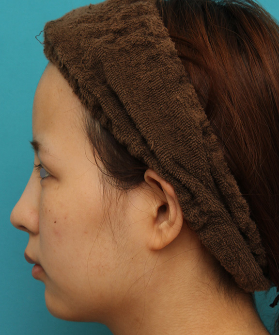 症例写真,顎にシリコンプロテーゼを入れ、Eラインを整えた20代女性の症例写真,After（6ヶ月後）,ba_ago014_b03.jpg