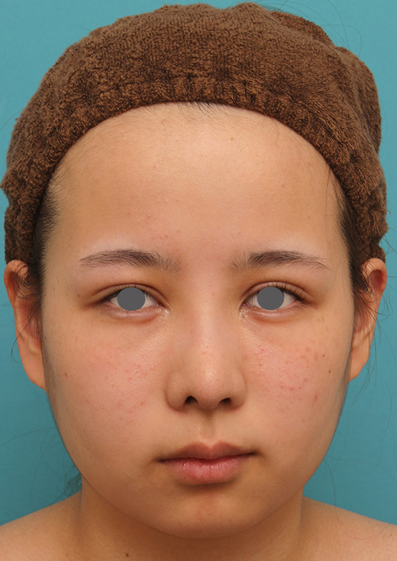 あご形成（シリコンプロテーゼ）,顎にシリコンプロテーゼを入れ、Eラインを整えた20代女性の症例写真,Before,ba_ago014_b01.jpg