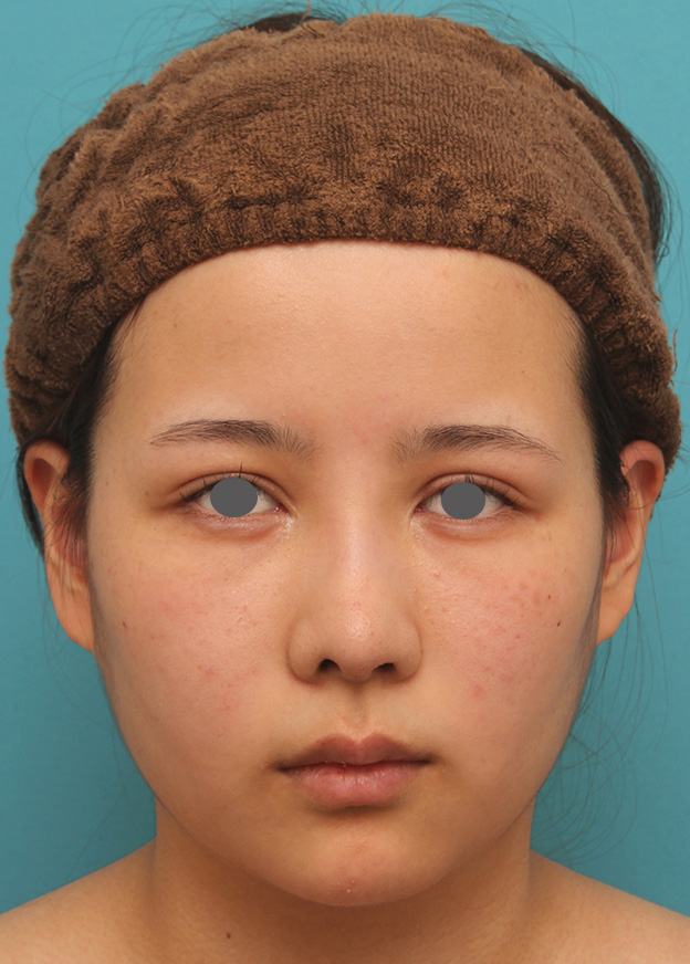 症例写真,顎にシリコンプロテーゼを入れ、Eラインを整えた20代女性の症例写真,3週間後,mainpic_ago014d.jpg