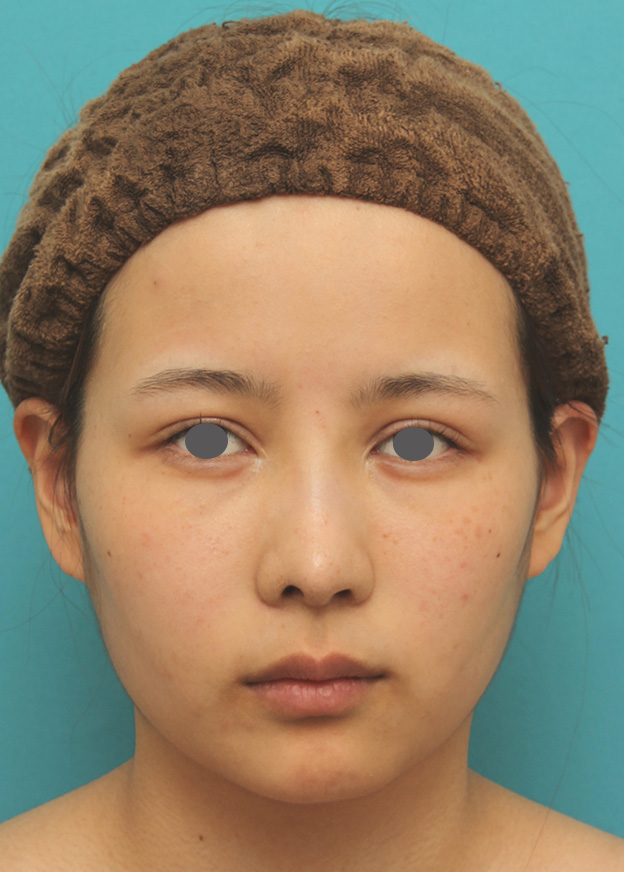 症例写真,顎にシリコンプロテーゼを入れ、Eラインを整えた20代女性の症例写真,2ヶ月後,mainpic_ago014e.jpg