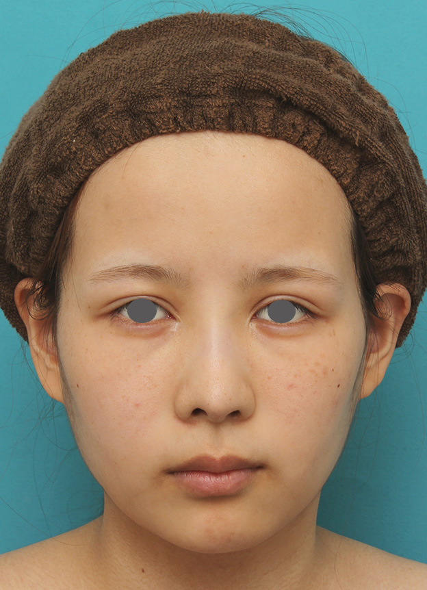 症例写真,顎にシリコンプロテーゼを入れ、Eラインを整えた20代女性の症例写真,6ヶ月後,mainpic_ago014f.jpg