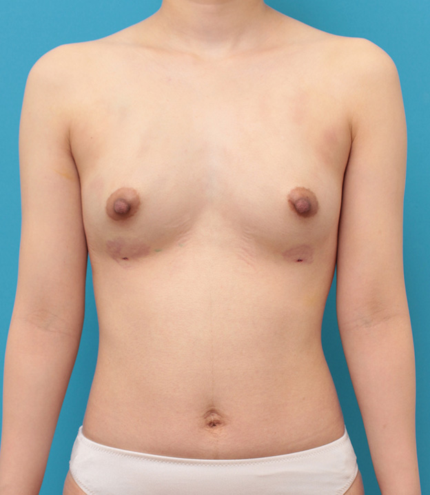 症例写真,痩せている女性の太もも、お尻から脂肪吸引し、バストに脂肪注入豊胸した症例写真,手術直後,mainpic_shibokyuin032l.jpg
