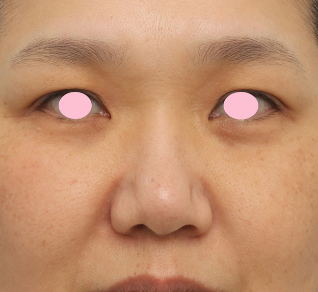 症例写真,団子鼻の鼻先と小鼻へのメソシェイプフェイス（脂肪溶解注射）の症例写真,治療前,mainpic_meso_hanasaki001a.jpg
