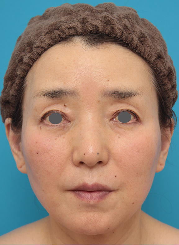症例写真,ウルセラシステム+サーマクール+ヒアルロン酸注射した症例写真,After（3ヶ月後）,ba_ulthera021_b01.jpg