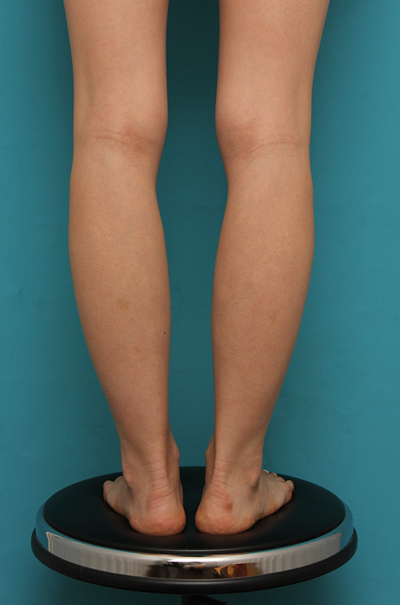 細い脚にボツリヌストキシン注射（ふくらはぎ・足やせ・美脚）を行い、更に細くした症例写真,Before,ba_leg009_b01.jpg