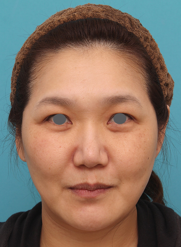 症例写真,頬、フェイスライン、二重顎に小顔専用脂肪溶解注射メソシェイプフェイスをした症例写真,After（5回注射後1ヶ月）,ba_meso_face004_b01.jpg