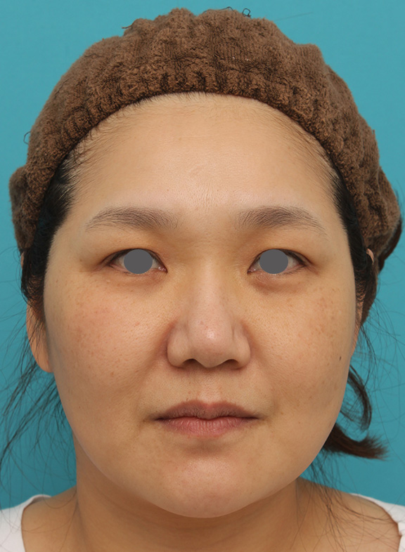 症例写真,頬、フェイスライン、二重顎に小顔専用脂肪溶解注射メソシェイプフェイスをした症例写真,Before,ba_meso_face004_b01.jpg