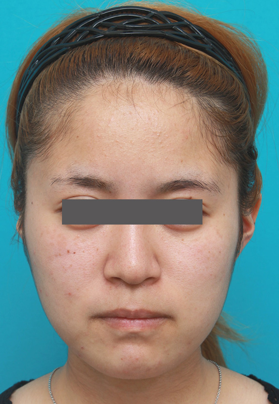 症例写真,顎のヒアルロン酸注射でシャープなフェイスラインにした症例写真,Before,ba_agochu011_b01.jpg