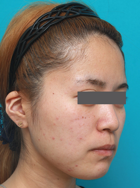 症例写真,顎のヒアルロン酸注射でシャープなフェイスラインにした症例写真,Before,ba_agochu011_b02.jpg