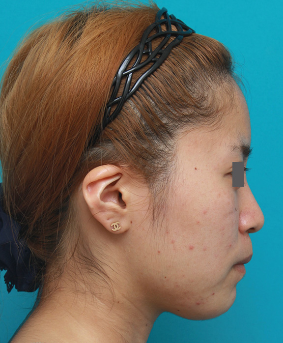 症例写真,顎のヒアルロン酸注射でシャープなフェイスラインにした症例写真,Before,ba_agochu011_b03.jpg