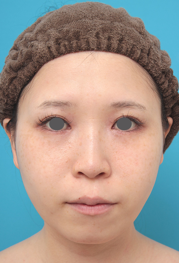 シリコンプロテーゼで顎を下方向に出さずに前方にのみ出した症例写真 美容整形の高須クリニック 東京赤坂 横浜 名古屋 大阪