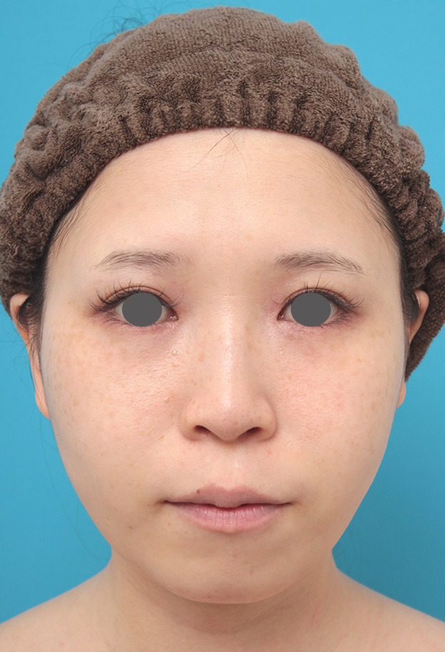 症例写真,シリコンプロテーゼで顎を下方向に出さずに前方にのみ出した症例写真,手術前,mainpic_ago015a.jpg