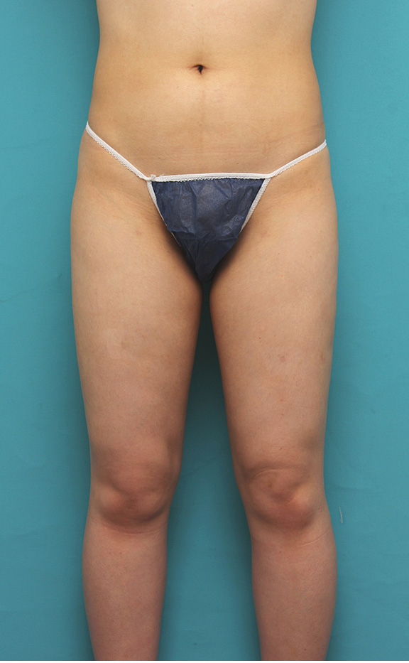 脂肪吸引,20代女性のお尻と太もも全体の脂肪吸引をした症例写真,After（6ヶ月後）,ba_shibokyuin033_a01.jpg