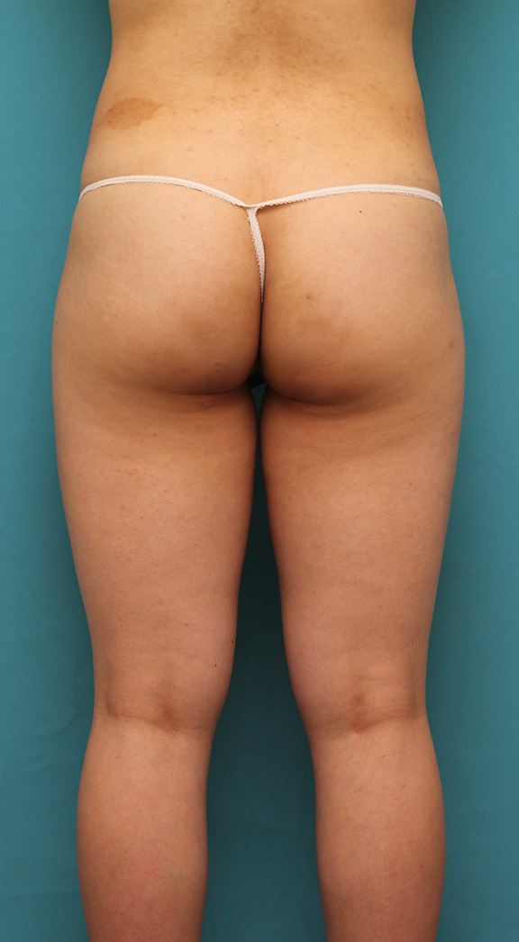 症例写真,20代女性のお尻と太もも全体の脂肪吸引をした症例写真,Before,ba_shibokyuin033_b02.jpg
