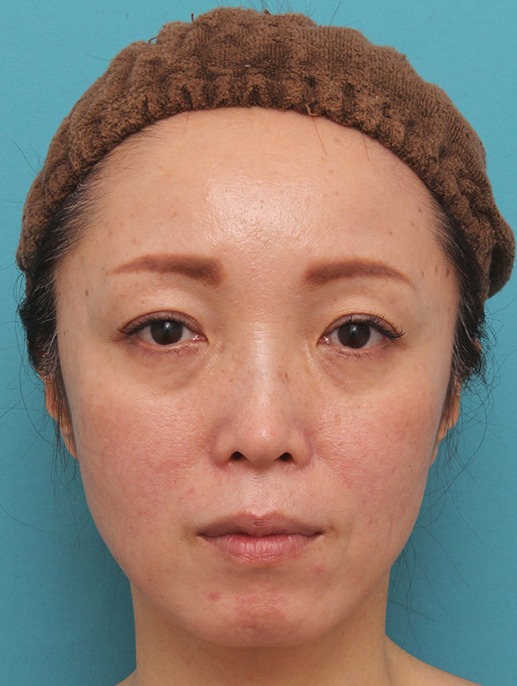頬が痩けている女性にチークヒアルで肌の張りを出した症例写真,After（注射後1ヶ月）,ba_cheek001_a01.jpg