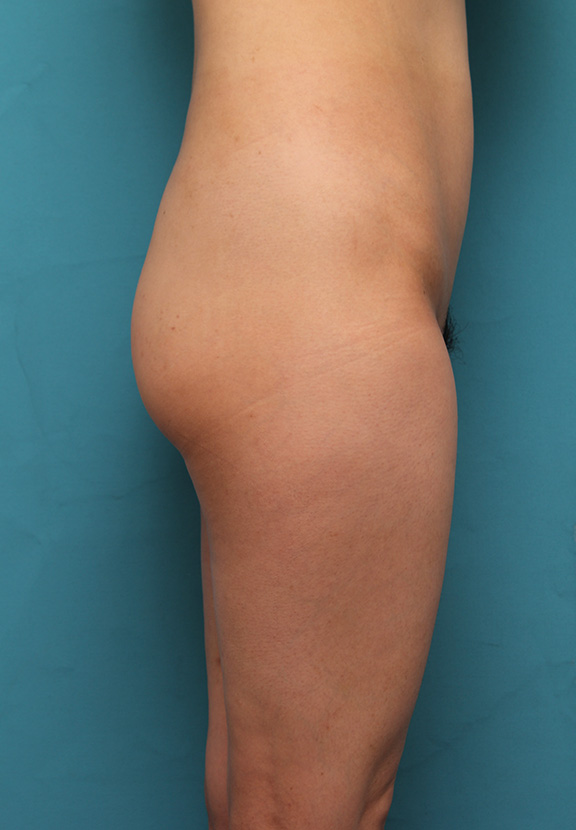 症例写真,お尻を膨らませて張りを出すヒップヒアル（お尻のヒアルロン酸注射）の症例写真,Before,ba_hip_hyaluron001_b02.jpg