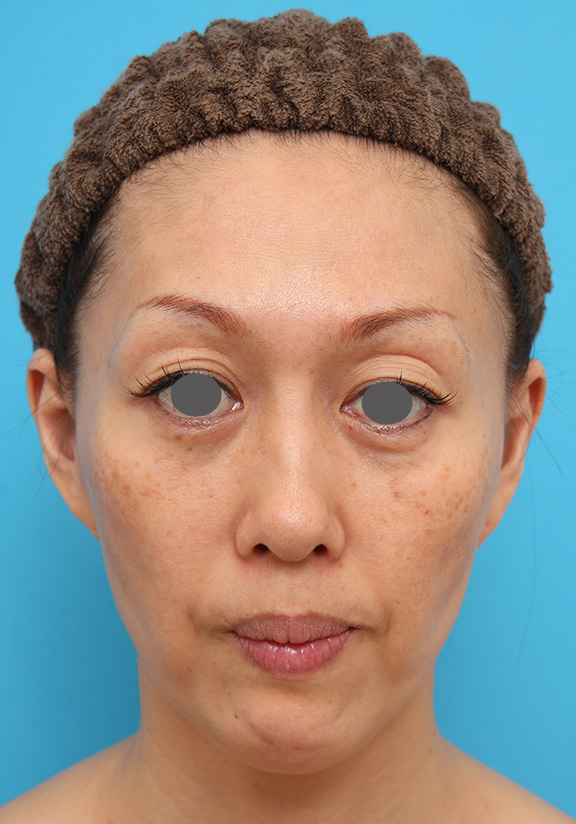 40代後半女性の引っ込んでいる顎にシリコンプロテーゼを入れた症例写真,After（6ヶ月後）,ba_ago016_a01.jpg