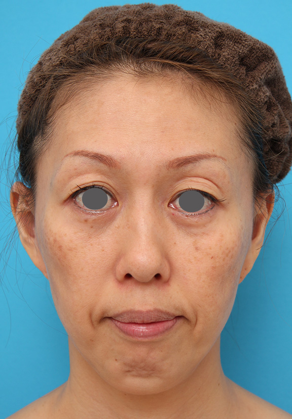 40代後半女性の引っ込んでいる顎にシリコンプロテーゼを入れた症例写真,Before,ba_ago016_b01.jpg