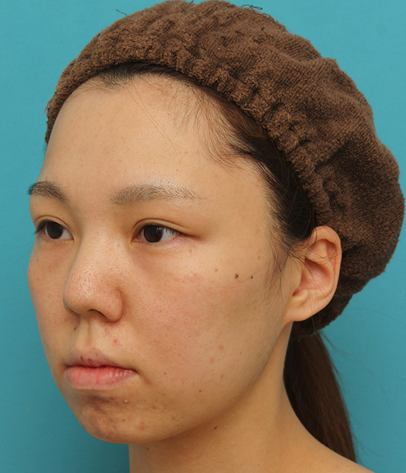 症例写真,鼻中隔延長で鼻先を斜め下方向に出した症例写真,Before,ba_bichukaku002_b02.jpg