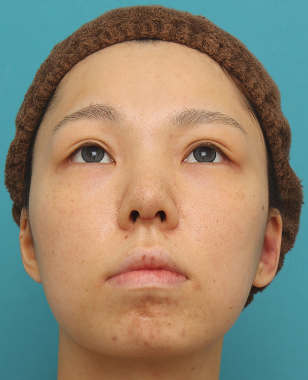 症例写真,鼻中隔延長で鼻先を斜め下方向に出した症例写真,1週間後,mainpic_bichukaku002g.jpg