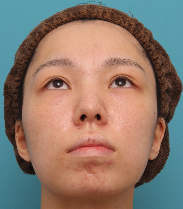 症例写真,鼻中隔延長で鼻先を斜め下方向に出した症例写真,6ヶ月後,mainpic_bichukaku002h.jpg