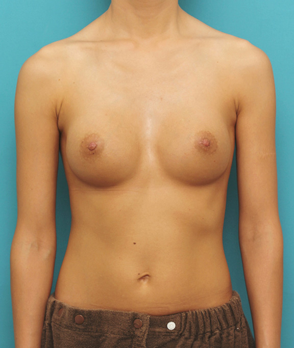症例写真,シリコンバッグプロテーゼ豊胸と乳頭縮小手術を同時に行った症例写真,After（6ヶ月後）,ba_hokyo026_b01.jpg