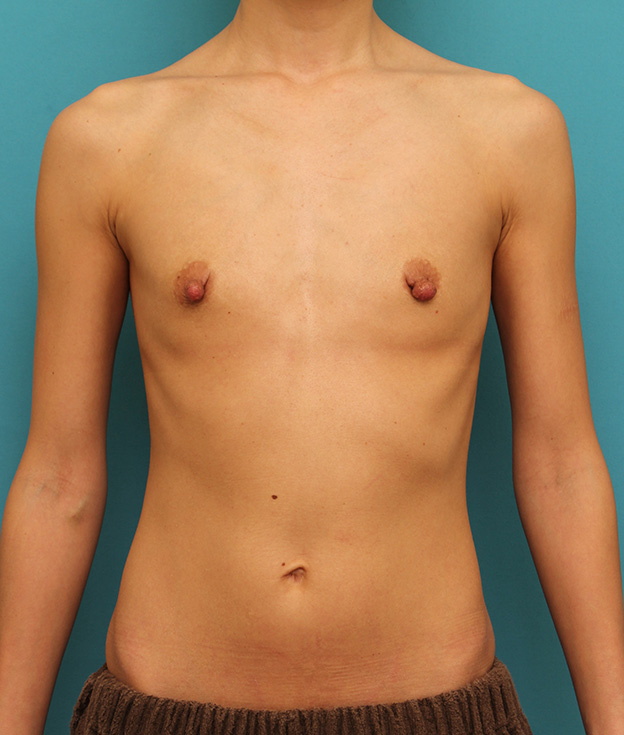 症例写真,シリコンバッグプロテーゼ豊胸と乳頭縮小手術を同時に行った症例写真,手術前,mainpic_hokyo026a.jpg