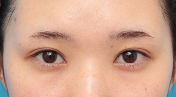 目頭切開でキツくなったり寄り目にならないように自然に目を大きくした症例写真,After（3ヶ月後）,ba_megashira052_a01.jpg