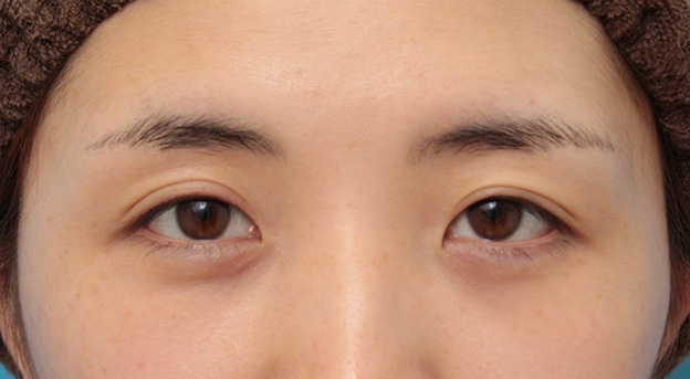 症例写真,目頭切開で、平行型二重のまま目を内側に広げた症例写真,手術前,mainpic_megashira053a.jpg