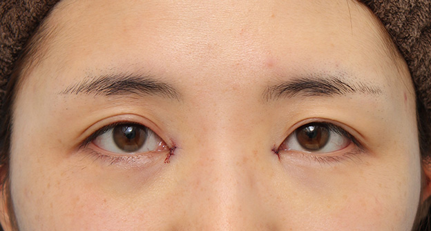 症例写真,目頭切開で、平行型二重のまま目を内側に広げた症例写真,手術直後,mainpic_megashira053b.jpg